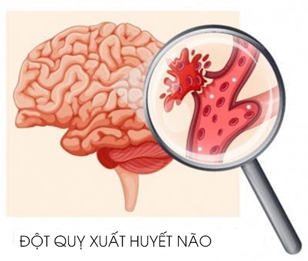 Chẩn đoán và điều trị đột quỵ xuất huyết não tự phát