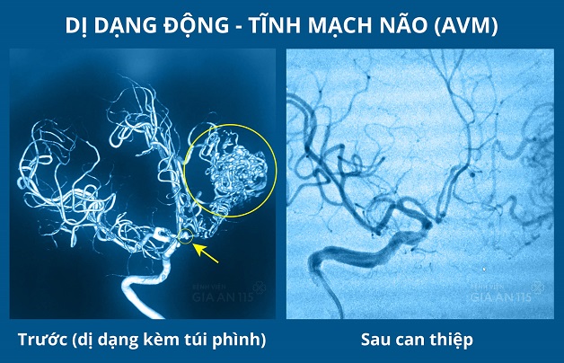 Chẩn đoán và điều trị đột quỵ xuất huyết não tự phát