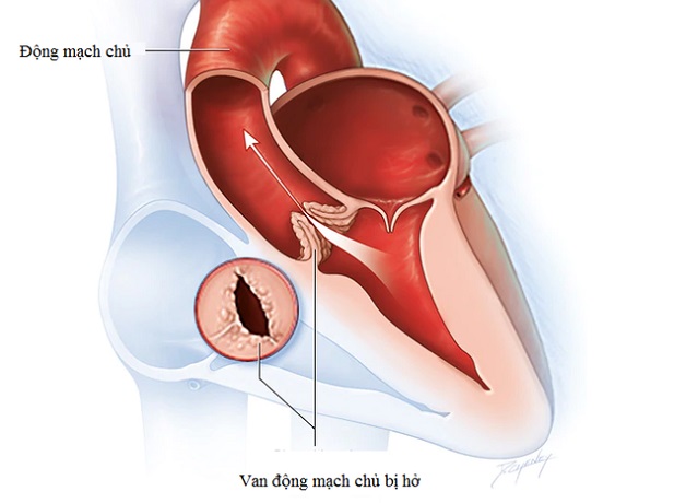 Chẩn đoán và điều trị hở van động mạch chủ