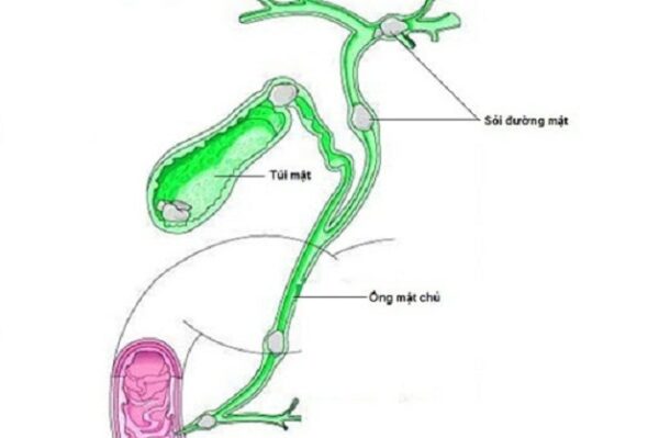 Chẩn đoán và phác đồ điều trị sỏi đường mật hiệu quả