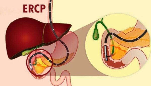 Chẩn đoán và phác đồ điều trị sỏi đường mật hiệu quả