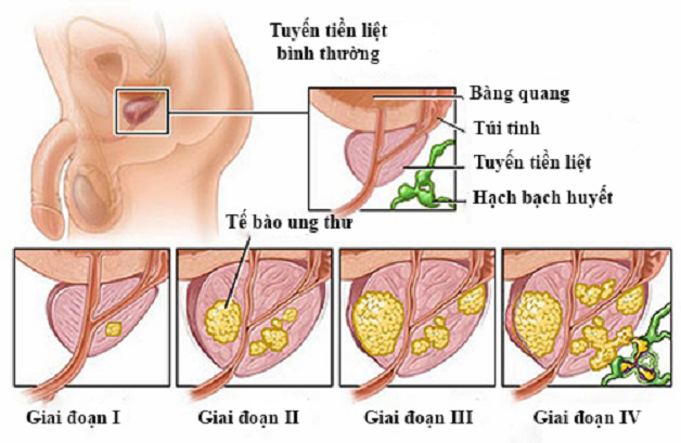 Chẩn đoán và xét nghiệm ung thư tuyến tiền liệt bằng cách nào?