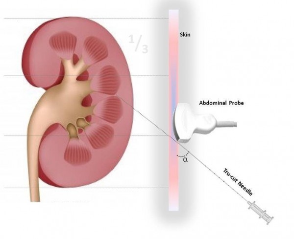 Chẩn đoán viêm cầu thận thăm khám bệnh khác