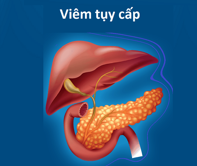 Chẩn đoán viêm tụy cấp và những điều cần lưu ý