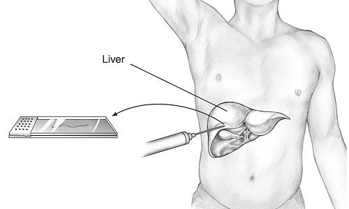 Chẩn đoán xơ gan điều trị kịp thời là rất quan trọng