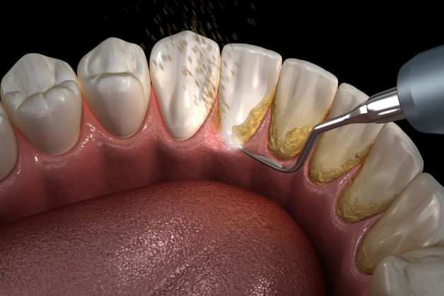 Chân răng bị sưng mủ là bệnh gì?