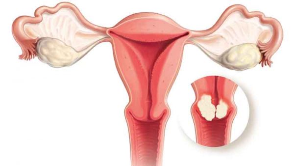 Chảy máu khi quan hệ: Điểm mặt những bệnh ung thư có liên quan