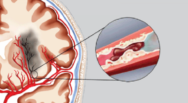 Chảy máu não có nguy hiểm không?