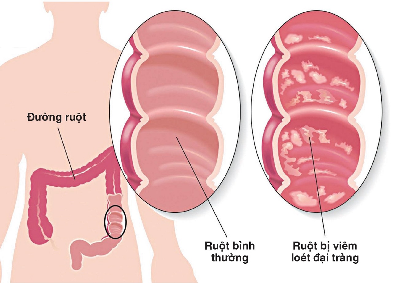 Chế độ ăn cho người bị đại tràng để nhanh hồi phục