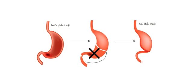 Chế độ ăn sau phẫu thuật ung thư dạ dày hiệu quả