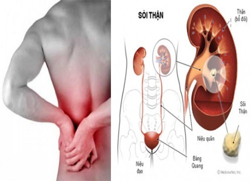 Chế độ ăn tốt cho người sỏi thận