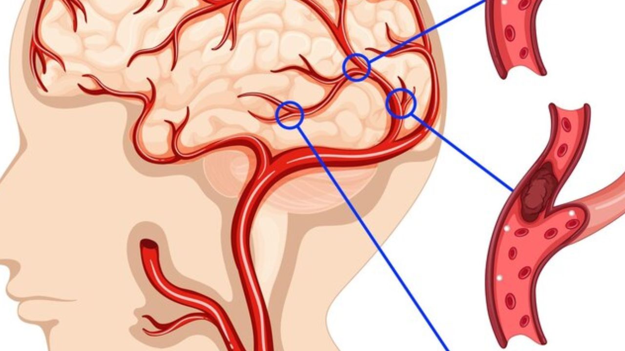 Chế độ chăm sóc bệnh nhân nhồi máu não giai đoạn sớm