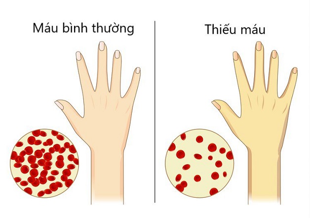 Chế độ dinh dưỡng bệnh thiếu máu dinh dưỡng ở trẻ em