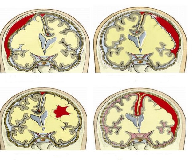 Chỉ định chụp CT scan sọ não khi nào?