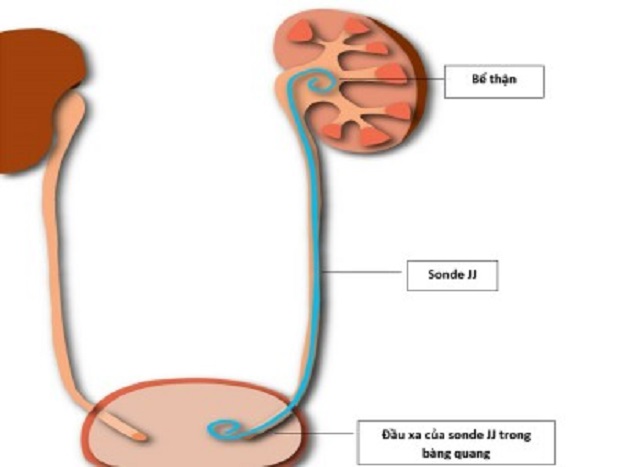 Chỉ định phẫu thuật nội soi sau phúc mạc lấy sỏi