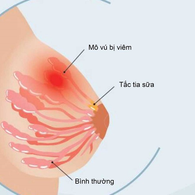 Chị em đã biết về chữa tắc tia sữa bằng sóng siêu âm?