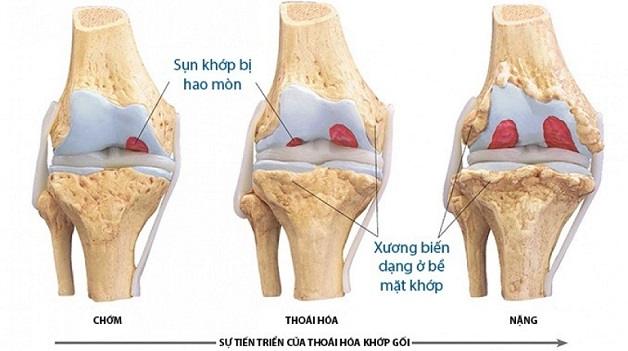 Chi phí chụp mri khớp gối hiện nay là bao nhiêu?