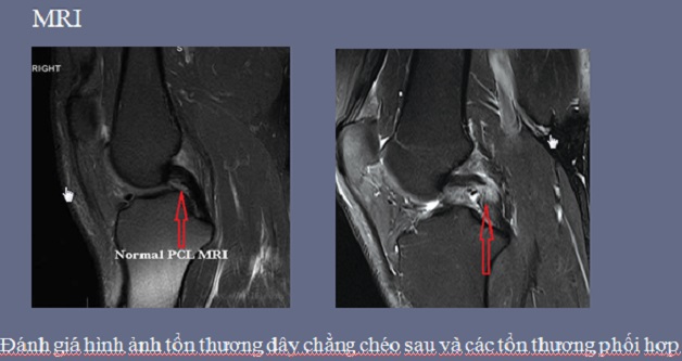 Chi phí chụp mri khớp gối hiện nay là bao nhiêu?