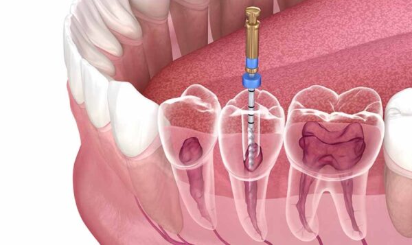 Chi phí điều trị tủy răng – cập nhật mới nhất