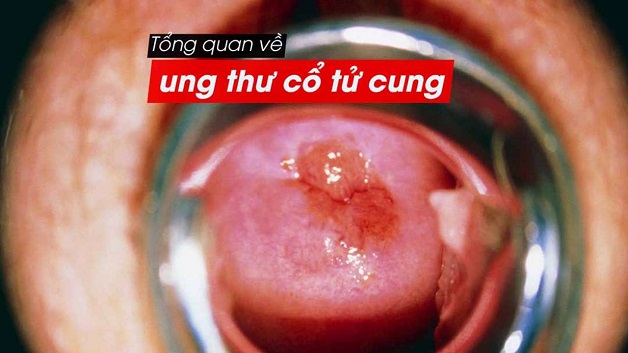 Chi phí điều trị ung thư cổ tử cung và những điều cần biết