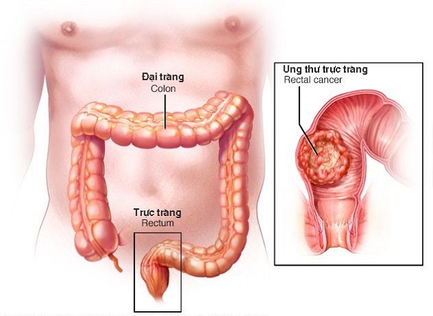 Chi phí điều trị ung thư đại trực tràng có đắt không?