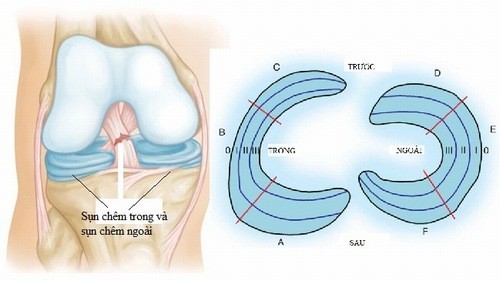 Chi phí mổ rách sụn chêm bao nhiêu?