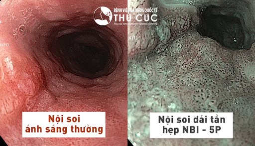 Chi phí nội soi dạ dày đại tràng với công nghệ NBI 5P