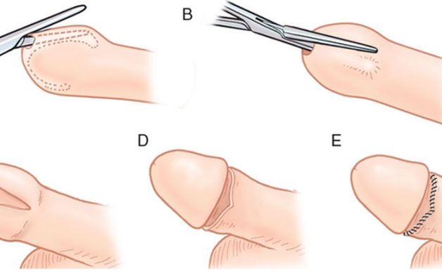 Chi phí phẫu thuật cắt bao quy đầu bao gồm những khoản nào?