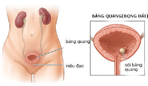 Chi phí tán sỏi bàng quang là bao nhiêu?