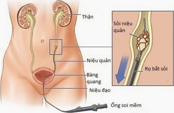 Chi phí tán sỏi niệu quản ngược dòng giá bao nhiêu?