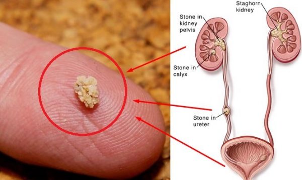 Chi phí tán sỏi niệu quản và những điều cần lưu ý