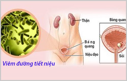 Chi phí tán sỏi thận ngoài cơ thể có cao không? – góc giải đáp