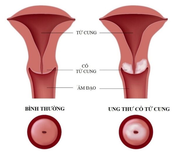 Chi phí tiêm vacxin ung thư cổ tử cung và những điều cần biết