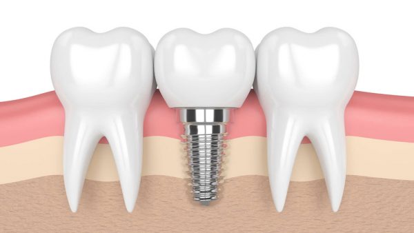 Chi phí trồng răng hàm hết bao nhiêu tiền hiện nay?