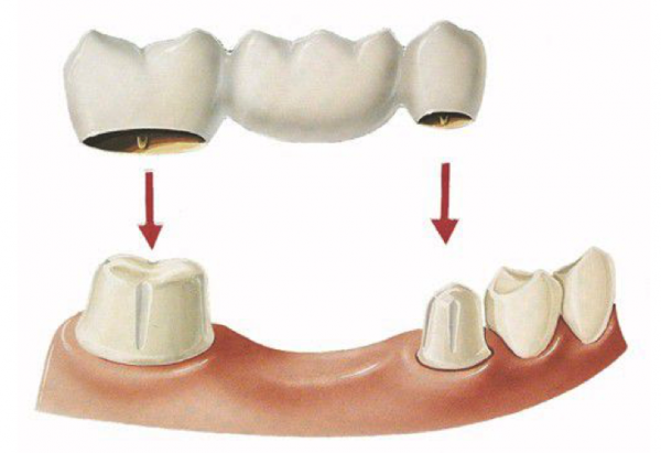 Chi phí trồng răng hàm hết bao nhiêu tiền hiện nay?