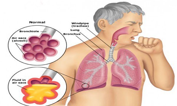 Chỉ số cyfra 21 – 1: tăng cao chưa chắc do ung thư phổi