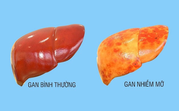 Chỉ số gan nhiễm mỡ bạn cần đặc biệt lưu tâm