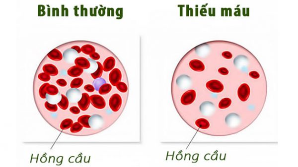 Chỉ số hồng cầu thấp khi nào? các tế bào trong cơ thể