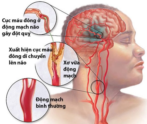 Chỉ số mỡ máu cao coi chừng bệnh tai biến mạch máu não