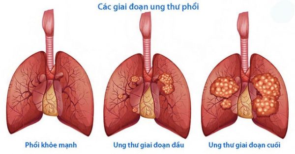 Chỉ số PDW là gì? PDW tác động gì đến sức khỏe?