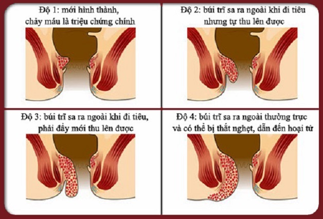 [Chi tiết] Kinh nghiệm đi cắt trĩ từ A đến Z