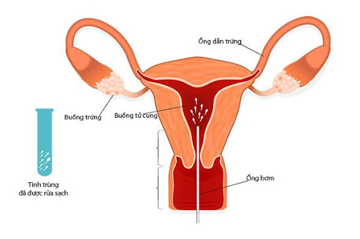 Chi tiết kỹ thuật bơm tinh trùng vào buồng tử cung