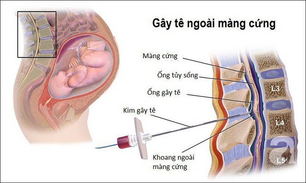 Chi tiết quy trình gây tê ngoài màng cứng trong chuyển dạ