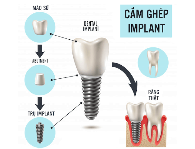 Chi tiết ưu và nhược điểm của các phương pháp trồng răng