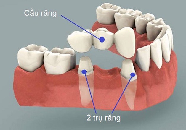 Chi tiết ưu và nhược điểm của các phương pháp trồng răng