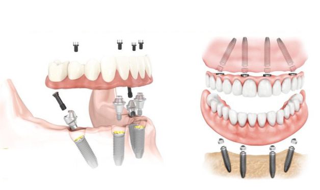 Chi tiết ưu và nhược điểm của các phương pháp trồng răng