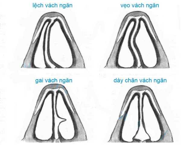 chinh vach ngan mui 1