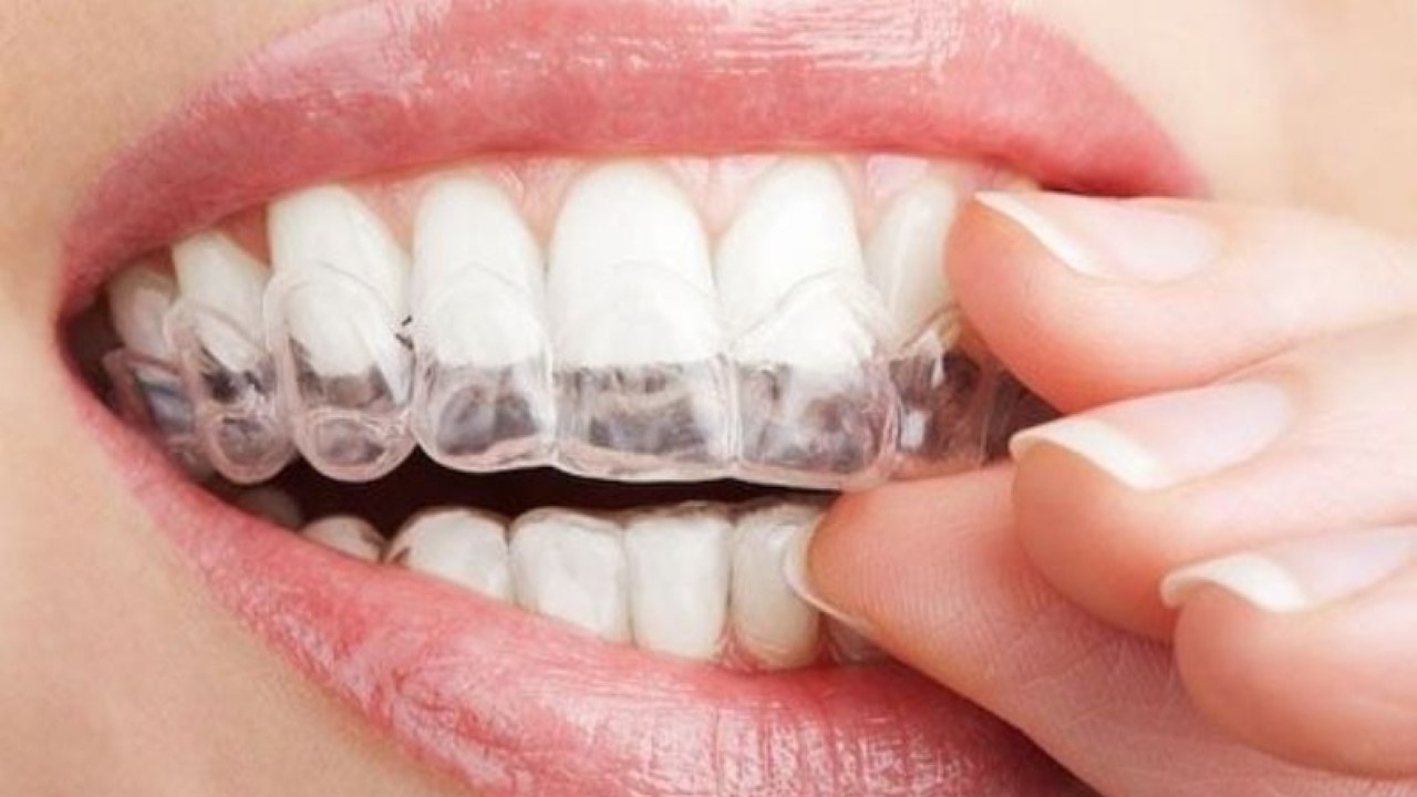 Chỉnh nha thoải mái hơn với niềng răng trong suốt Invisalign