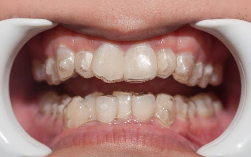 Chỉnh nha thoải mái hơn với niềng răng trong suốt Invisalign