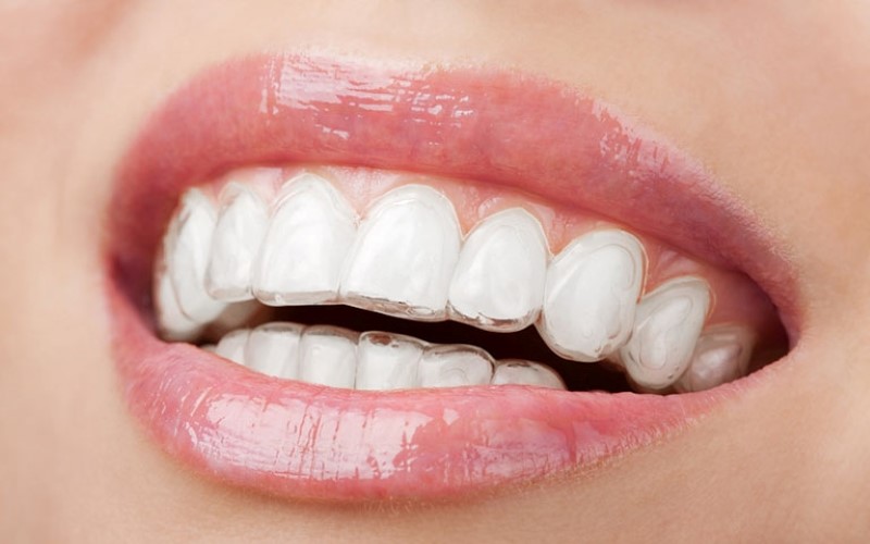 Chỉnh nha thoải mái hơn với niềng răng trong suốt Invisalign